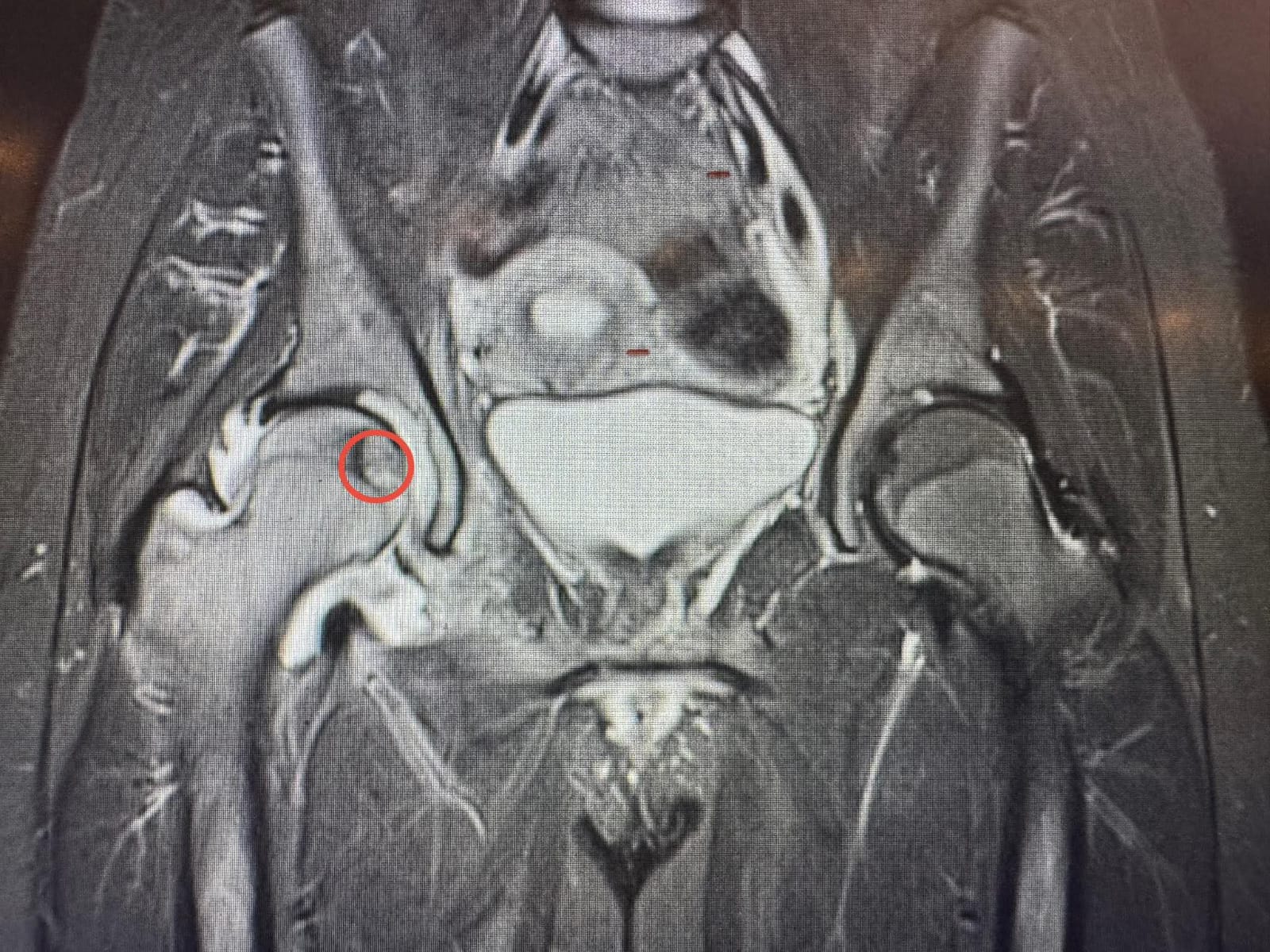 تدخلٌ علاجيٌّ نوعيّ في مستشفى الجامعة الأردنيّة باستخدام تقنيّة الكي بالمايكروويف لعلاج ورم في رأس عظم الفخذ